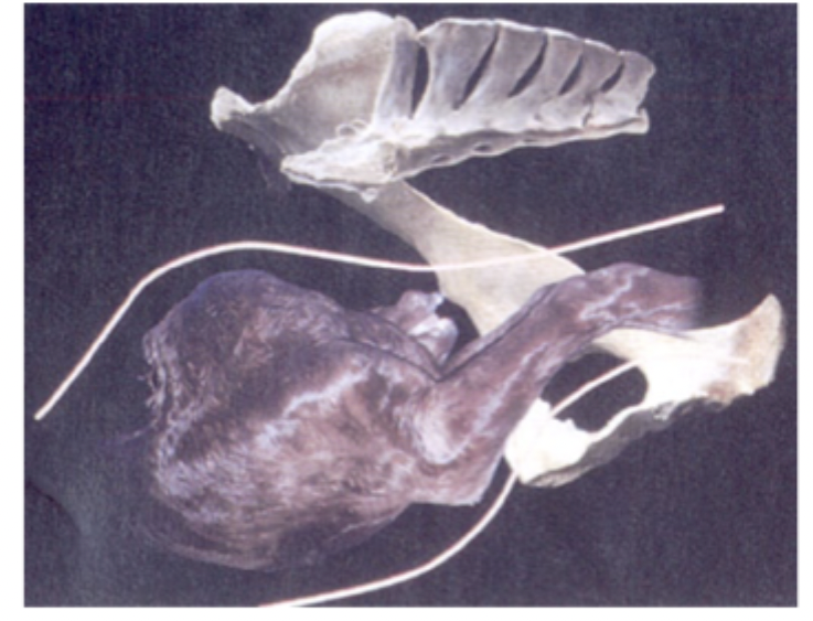 <p>What abnormality (shown in the image) is the same as flexed neck, but impossible to correct since the spine is fixed in this position, meaning it is not agreeable with life and may require fetotomy or C-section?</p>