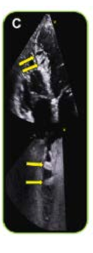 <p>what does this image show? where are the found? and are more common in pt with what?</p>