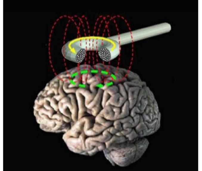 <p><strong>opto-</strong>: manipulate neuronal activity w/ light</p><ul><li><p>by <u>activating w/ Channel Rhodopsin</u> (ChR2) → <u>dep-</u></p></li><li><p>by <u>silencing w/ Halo Rhodopsin</u> (eNpHR) → <u>hyper-</u></p></li></ul><p>__</p><p>TMS</p><ul><li><p>uses a magnetic field to cause current flow in target brain areas</p></li><li><p>either <u>activate w/ brief pulses OR inactivate w/ high frequency pulses</u></p></li><li><p><u>lacks specific cell-type manipulation</u>, SO instead acts broadly/over a large area of different cell types</p></li></ul><p>(picture is of TMS)</p>