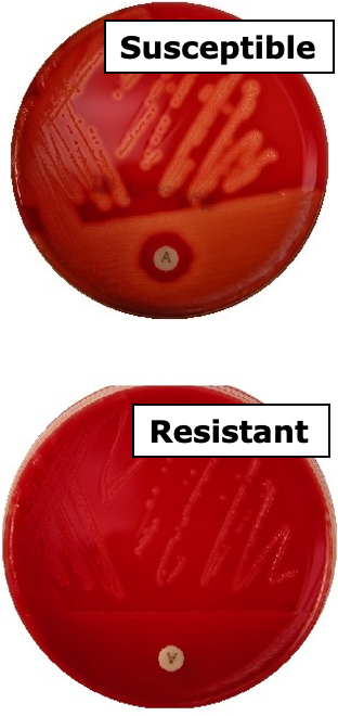 <p>An agar containing Streptococcus, in order to ID if it is Group A, a disk containing bacitracin is added. It inhibits the growth of Group A therefore any zone of inhibition is ‘suseptible’ and is presumptive for Group A</p><p></p><p>Susceptible: Streptococcus pyogenes (Group A Strep) —> any zone of inhibition >6mm</p><p>Resistant: Streptococcus agalactiae (Group B Strep)—> no zone of inhibition: 6mm</p><p></p><p>Note the disk itself is 6mm, so a resistant test is read as 6mm despite the bacterial growth being right up to the disk</p>