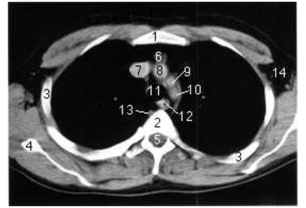 <ol><li><p>Sternum</p></li><li><p>corps vertébral</p></li><li><p>côtes</p></li><li><p>scapula</p></li><li><p>canal vertébral</p></li><li><p>tissu adipeux rétrosternal</p></li><li><p>veine cave supérieure</p></li><li><p>tronc brachiocéphalique</p></li><li><p>artère carotide commune gauche</p></li><li><p>artère subclavière gauche</p></li><li><p>trachée</p></li><li><p>oesophage</p></li><li><p>veine azygos</p></li></ol><p></p>