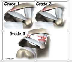 <p>What are the different grades of dislocation?</p>