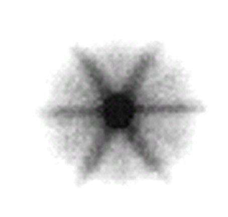 <p>What is the depicted abnormality?</p>