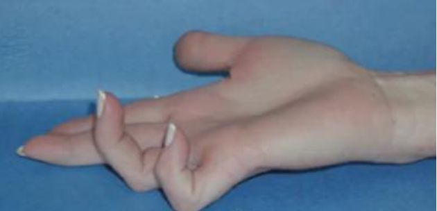 <p>Ulnar claw hand</p><ul><li><p>Caused by paralysis of the ulnar lumbricals and interossei → loss of MCP flexion and intrinsic control of the extensor mechanism in digits 4–5</p></li><li><p>Unopposed extensor digitorum hyperextends MCPs while FDP flexes PIP and DIP → claw posture</p></li><li><p>Finger flexion remains intact via FDS and FDP, but full finger extension is impaired due to loss of intrinsic muscle function</p></li></ul><p></p>