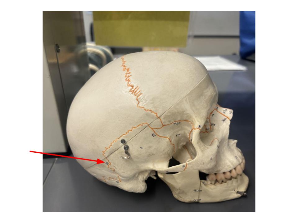 <p>between temporal and parietal bones</p>
