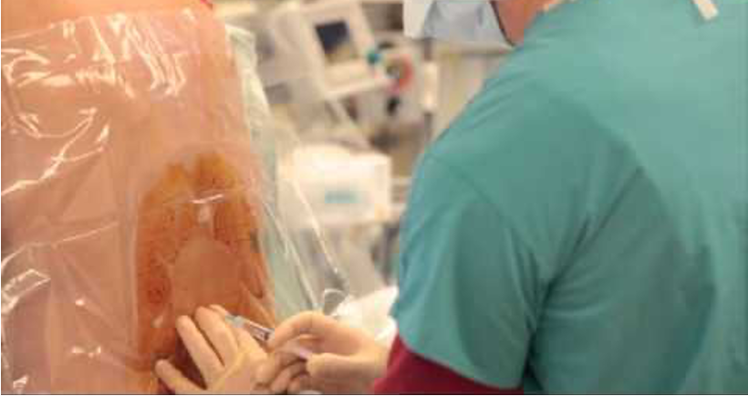 <ul><li><p><span>A single injection of local anesthetic (± opioid) into the subarachnoid space (CSF) at L3-L4 or L4-L5</span></p><ul><li><p><strong><span>Used for scheduled C-sections</span></strong></p></li></ul></li><li><p>Benefits</p><ul><li><p><span>Onset is very rapid (5-10 min)</span></p></li><li><p><span>Minimal fetal exposure</span></p></li><li><p><span>Limited duration (~1.5-3 </span><span style="font-family: "Aptos Light";"><span>hrs)</span></span></p></li></ul></li><li><p>Risks</p><ul><li><p><span>Possible hypotension</span></p></li><li><p><span>Post-dural puncture headache</span></p></li></ul></li></ul><p></p><p></p>