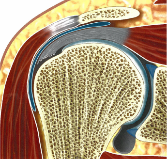 <p>Prone to retraction, acute repair needed </p>