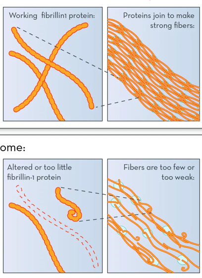 <p>Marfan System (believed that Abraham Lincoln had this condition), is a single gene mutation that causes longer extremities, vision problems, flexible joints, and heart defects because of a defect in the production of the fibrillin-1 protein</p>