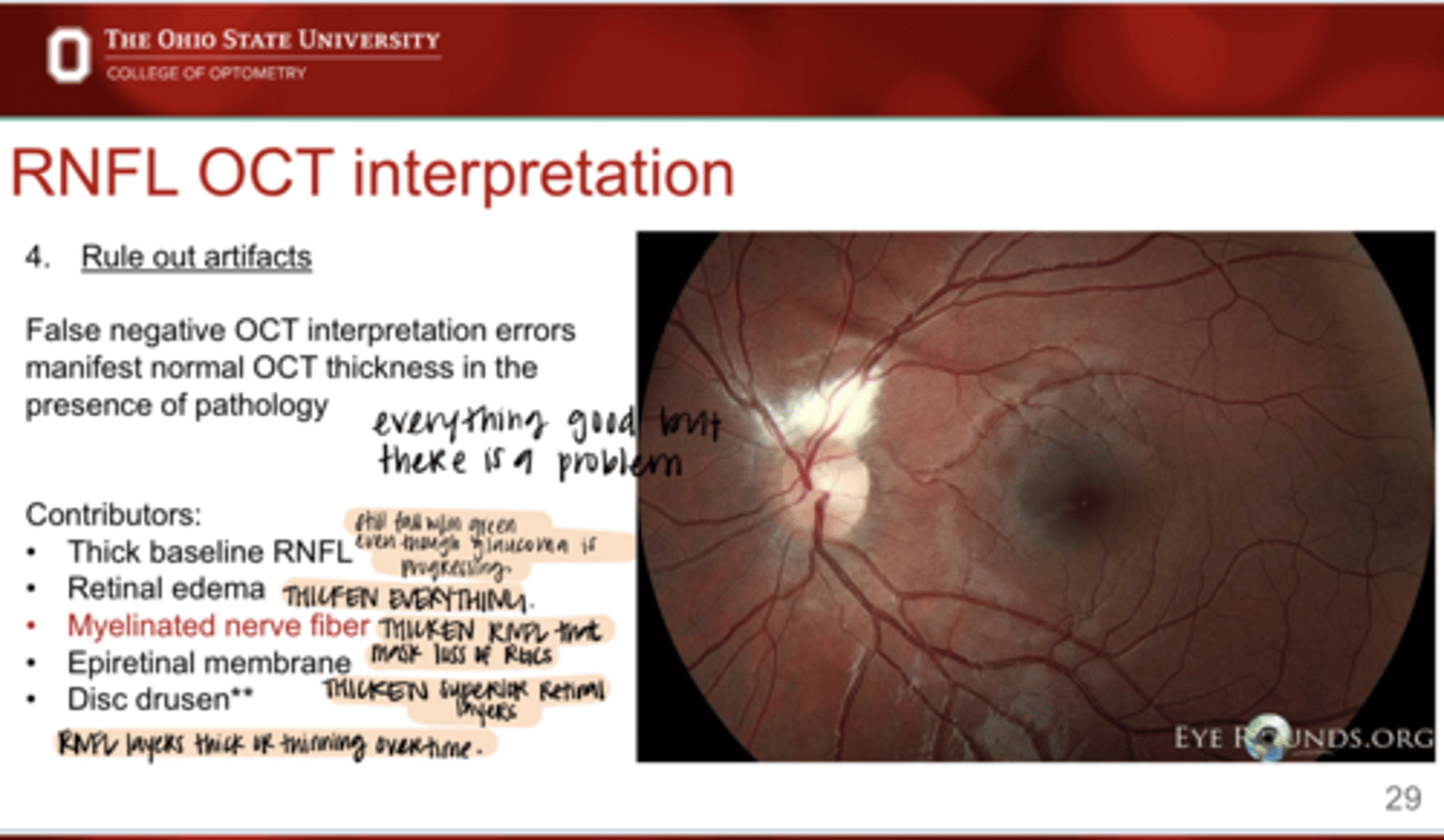 <p>False negative OCT interpretation errors manifest what?</p>
