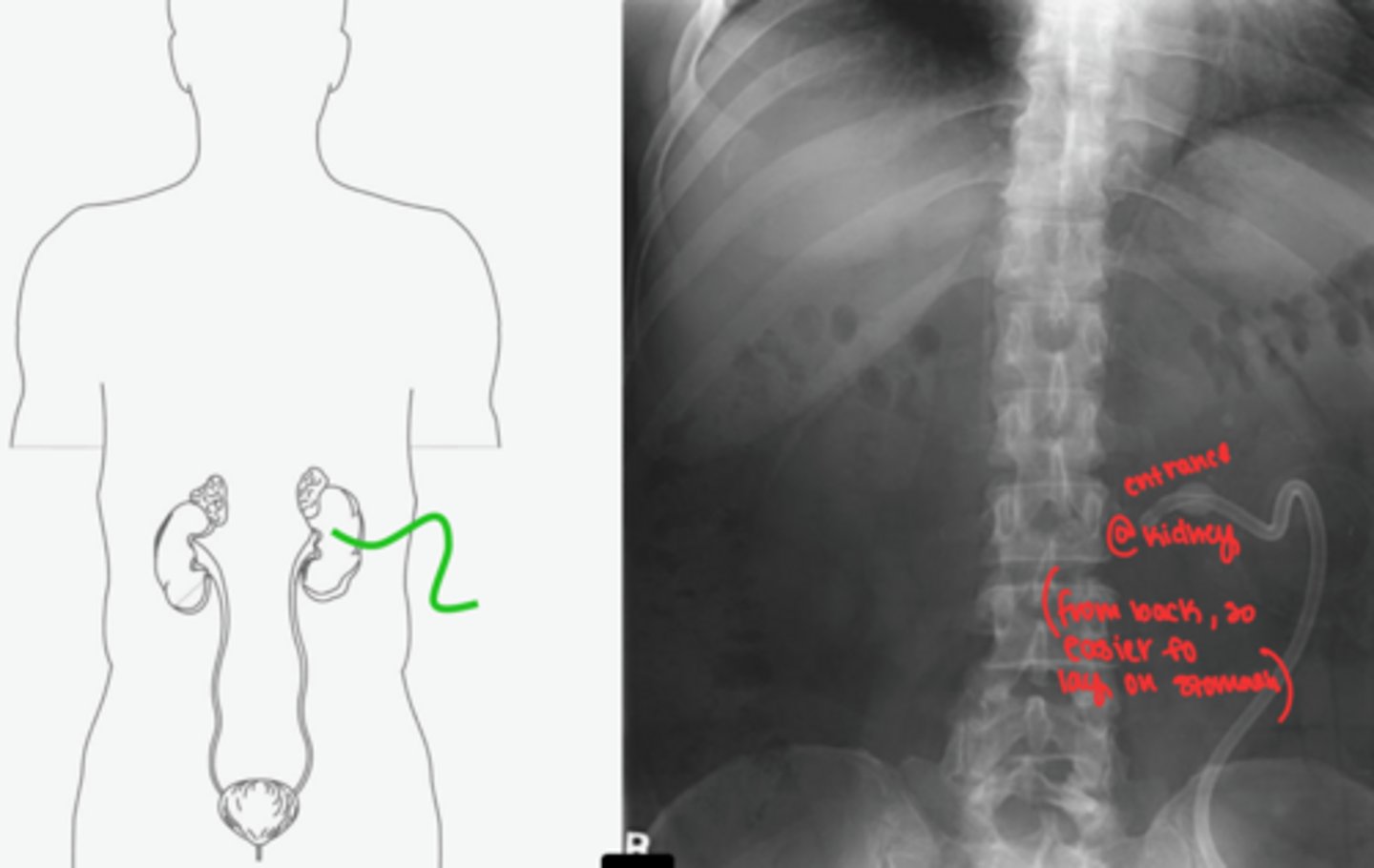 <p>sometimes x-ray for placement</p><p>percutaneous (placed in OR) through back into renal pelvis </p><p>entrance at kidney from back, exits outside body</p>