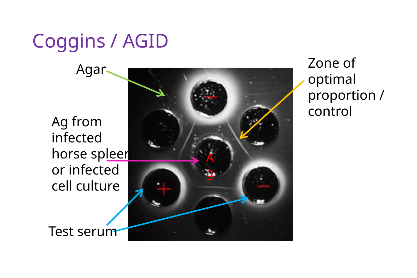 <p>The <strong>Coggins test</strong> is an <strong>AGID test</strong> used for <strong>equine infectious anemia (EIA)</strong>.</p><ul><li><p>AGID = agar gel immunodiffusion.</p></li><li><p>So it uses the same basic idea as the immunodiffusion card you just learned:</p><p></p><ul><li><p>Antigen and antibody diffuse through agar → if they recognize each other and meet in the right proportions → a visible precipitation line forms.</p></li></ul></li></ul><p></p><p>For Coggins, the test is looking for <strong>antibodies against equine infectious anemia virus</strong></p><p>So essentially:</p><p>“Does this horse have antibodies against EIA virus?”</p><p>If yes, that means the horse has been exposed/infected with the virus.</p><div data-type="horizontalRule"><hr></div><p><strong>Why does the test use serum instead of plasma?</strong></p><p>Remember:</p><p><strong>Serum = blood fluid after clotting, no fibrinogen</strong><br><strong>Plasma = blood fluid before clotting, still contains fibrinogen/clotting proteins</strong></p><p>The problem with plasma is that <strong>fibrin</strong> can form.</p><p>And fibrin can make its own cloudy/precipitated material in the agar and obscure the zones of optimal proportion<br><br>Another reason why Serum is preferred is because plasma contains anticoagulants, i.e. EDTA, which can dilute the blood sample</p>