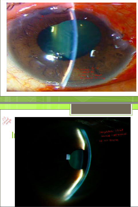 <p>lids/lashes/adnexa → MGC 2+</p><p>conjunctiva: hyper +1 OD, hyper 2+ OS</p><p>A/C: deep/quiet OD, OS look at image </p><p>patent LPI in OS (laser Sx pt couldn’t remember)</p><p>IOPs: OD 11, OS 52</p><p>gonio: OD SS seen in all quadrants, OS ant TM and SL seen 360 (closed)</p>