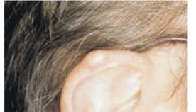 <p>Hard external ear nodules associated w/ deposits of uric acid crystals (seen in advanced gout)</p>