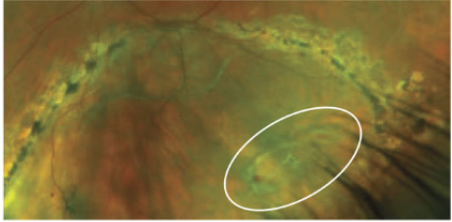 <ul><li><p>Full thickness hole or tear in the retina → vitreous seeps in → retina detaches from RPE</p></li><li><p>If lattice with holes → can cause chronic RD with pigment line demarcating </p></li></ul><p></p>