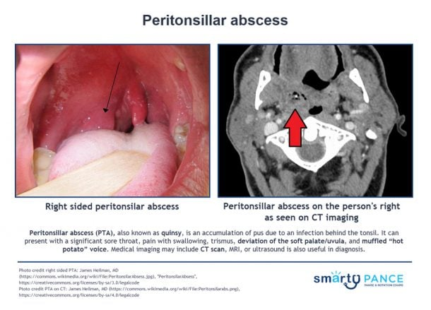 <p>Penetration of infection through the tonsillar capsule and the involvement of neighboring tissue</p><p>-Presentation: severe sore throat, lateral uvula displacement, and a bulging tonsillar pillar. Associated with a muffled “hot potato” voice </p><p>-Dx: x-ray, CT, or US of neck. Needle aspiration of the mass and cultures </p><p>-Tx: aspiration, I&D, parenteral amoxicillin/clindamycin or PO if less severe, tonsillectomy </p>