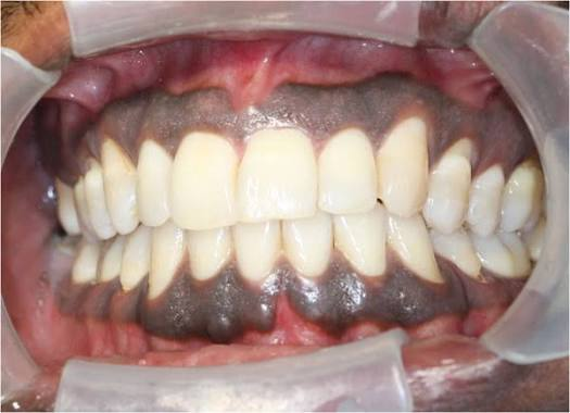 <ul><li><p>Can get melanin from smoking </p></li></ul><p></p>
