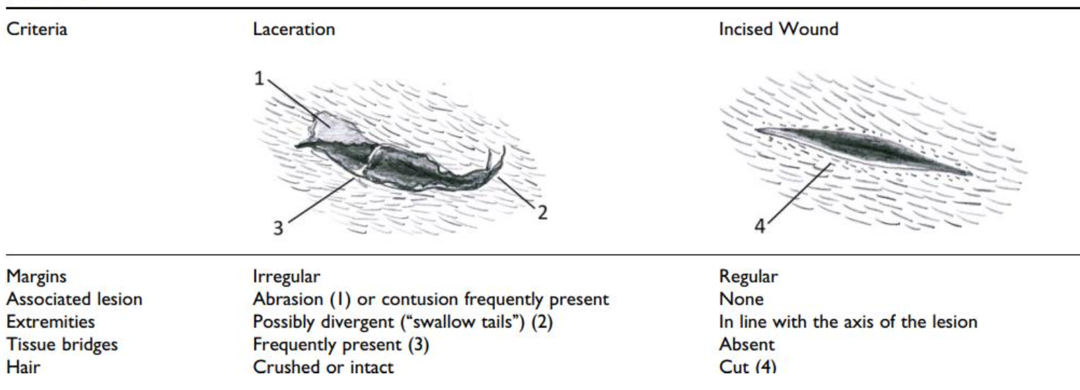 <p>Misidentifying a wound can <strong>mislead an investigation</strong> and result in <strong>incorrect conclusions about the cause or weapon used</strong>.</p><p class="isSelectedEnd"><strong>Key differences to document before treatment:</strong></p><ul><li><p><strong>Wound edges</strong> (clean vs irregular)</p></li><li><p><strong>Residual skin bridging</strong> (present in lacerations, absent in incised wounds)</p></li><li><p><strong>Bruising or abrasion</strong> around the wound</p></li><li><p><strong>Surrounding hairs</strong> (often <strong>crushed in lacerations</strong> from blunt force)</p></li></ul><p><strong>Importance:</strong><br>Accurate documentation helps determine <strong>how the wound was caused and whether a blunt or sharp object was involved</strong>.</p>