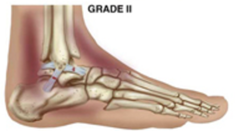 <p>- Significant incomplete tear</p><p>- Swelling, ecchymosis, LAXITY IN JOINT</p><p>treatment: immobilization, orthopedic follow-up</p>
