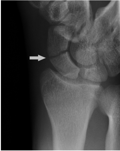 <p>FOOSH + tenderness over asb </p><p><em>note a specific scaphoid view is required xray</em></p>