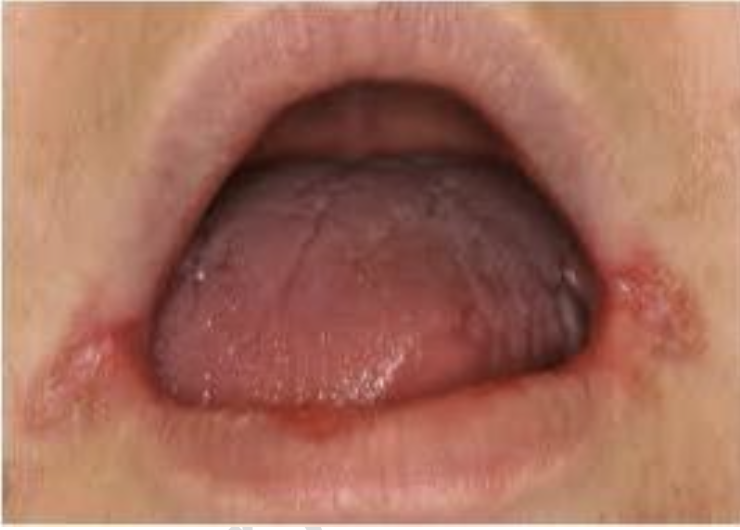 <p>The patient shown in the figure is suffering from denture stomatitis.</p><p>A. True </p><p>B. False</p>