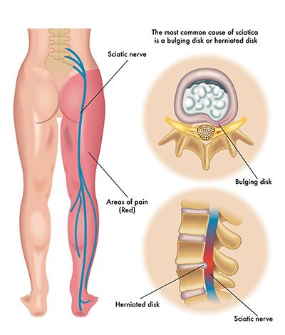 <p>Sciatic</p>