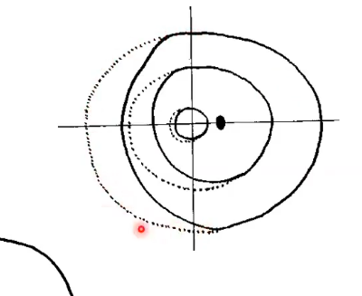 <p>constricted visual field </p>