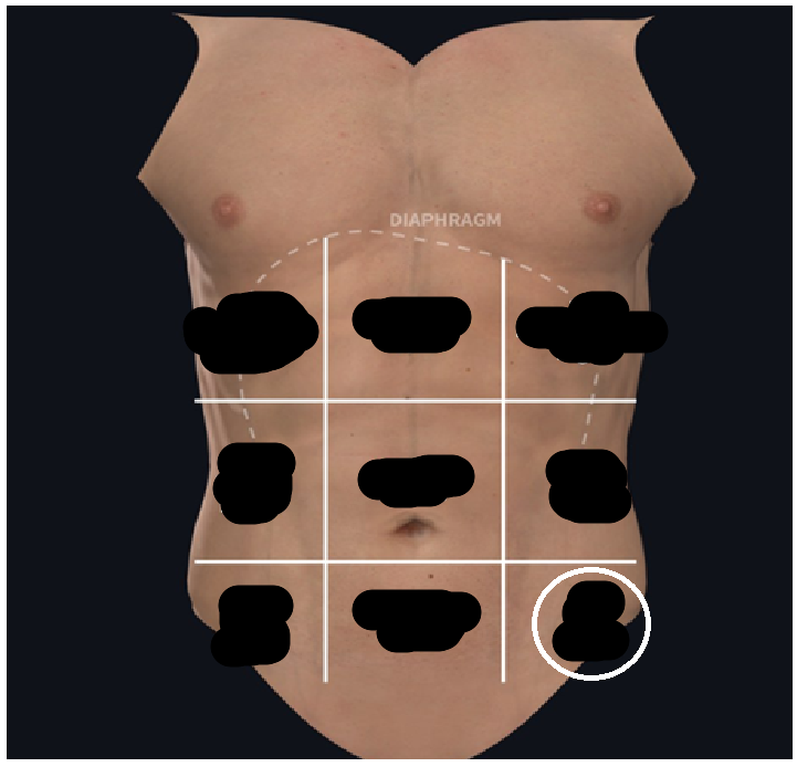 <ul><li><p><span style="background-color: transparent;">Lateral to hypogastric</span></p></li><li><p><span style="background-color: transparent;">At the groin</span></p></li></ul><p></p>