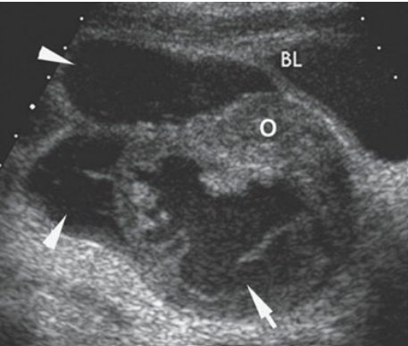 <p>Tubo-ovarian complex. Longitudinal transabdominal image of the adnexa revealing a complex adnexal mass (arrow) composed of a dilated fallopian tube (arrowheads) and enlarged ovary (O) seen posterior to the bladder (BL).</p>