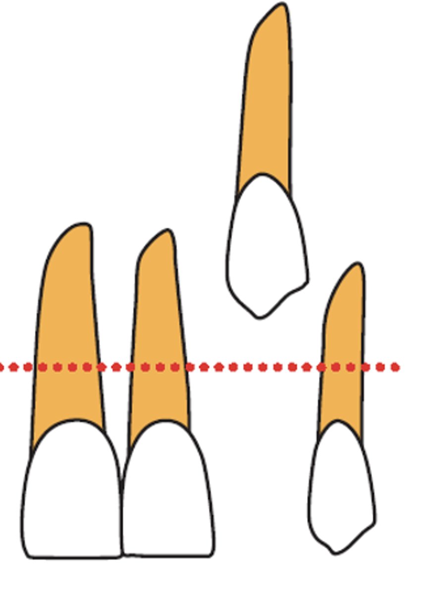 <p>What surgical technique is recommended?</p><p>- Canine cusp is <strong>significantly apical</strong> to the mucogingival junction (MGJ)</p>