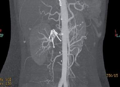 <p>What is the purpose of the device imaged below? </p><p>(This image shows vascular filling through the arteries only.)</p>