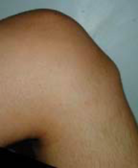 <p>CC: generalized anterior knee pain, worse with activity</p><p>- Swelling and pain at tibial tubercle</p><p>- During phases of rapid growth</p>
