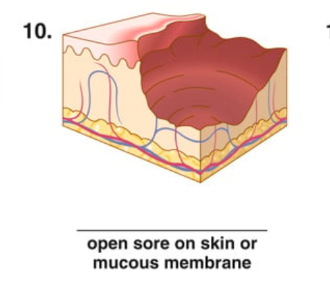 <p>open sore on skin or mucous membrane</p>