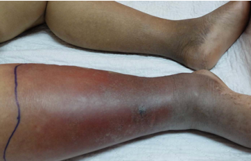 <p>What is cellulitis and its cause? </p>