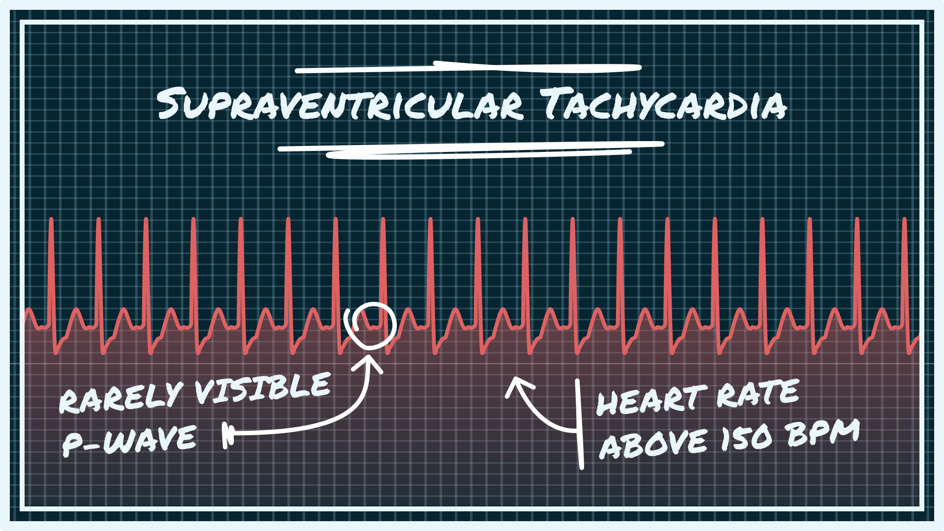 <p>A supraventricular impulse with normal ventricular conduction.</p>