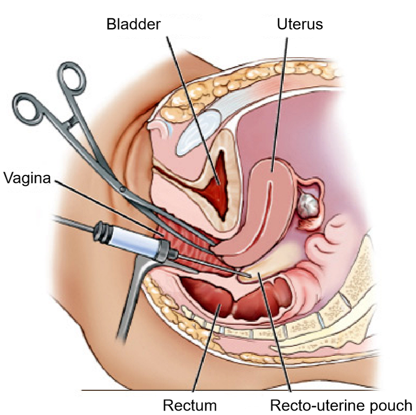<p>By puncturing the back of the vag!na with a probe to drain fluid</p>