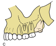 <p>most difficult for maxillary</p><p>opposite of mandible → overlying posterior bone is thicker, access limited by second molar</p><p></p><p><em>[ for maxillary teeth, mesioangular impactions are the most difficult, while vertical/distoangular are easier ]</em></p>