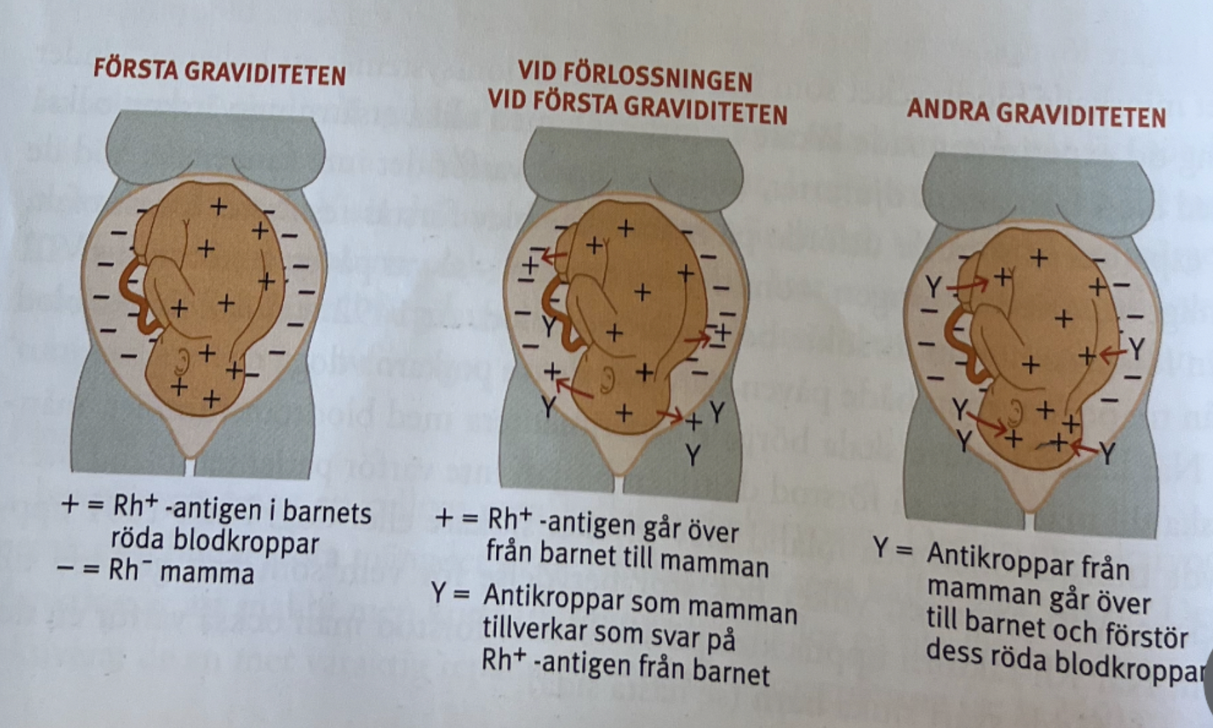 <p><span style="background-color: transparent; font-family: "Cormorant Garamond", serif;">Om en RH- kvinna blir gravid och barnet är RH+ kommer <strong>RH-faktorer läcka in </strong>från fostrets blodomlopp till mammans blodomlopp som börjar<strong> skapa antikroppar </strong>mot RH-faktorerna. Under första graviditeten skapar detta <u>inget problem</u>, men om mamman blir gravid igen och det fostret också har RH+ blod => <u>antikroppar mot RH-faktorerna läcker över</u> från mamman till fostret och <strong>orsakar skador i hjärnan.&nbsp;</strong></span></p><ul><li><p><span style="background-color: transparent; font-family: "Cormorant Garamond", serif;">Sjukvården ger medicin till RH- kvinnor under graviditet + förlossning som minskar antikroppsproduktionen.</span></p></li></ul><p></p>