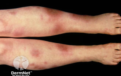 <p>sarcoidosis: tender red patches on skin</p>