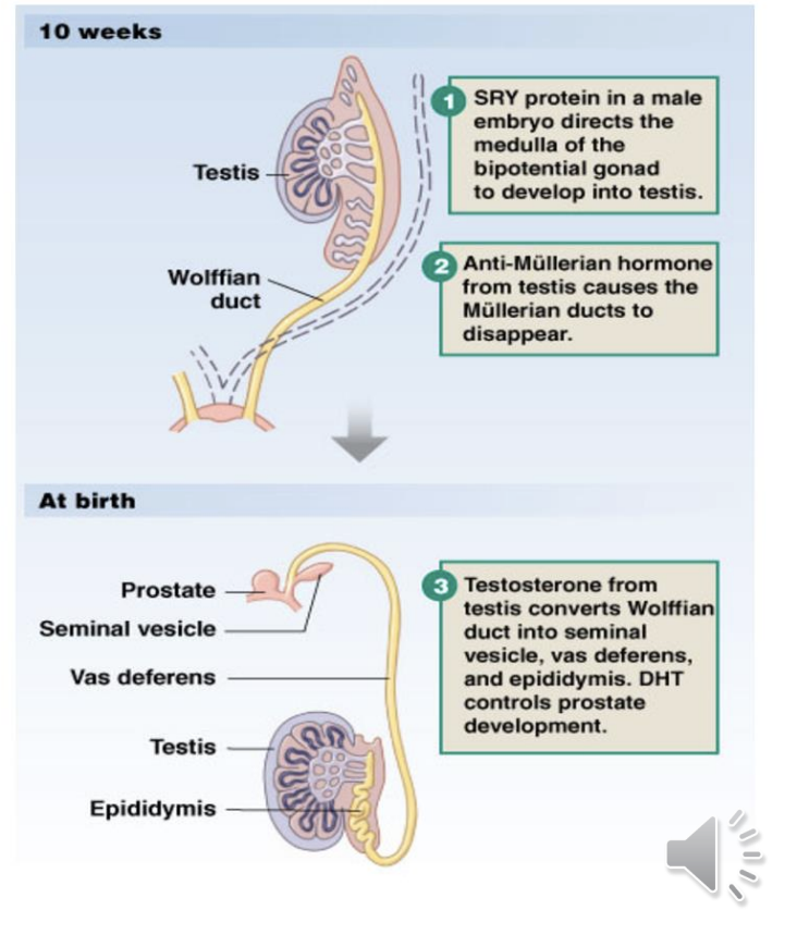 <p>Gonadal cortex regresses.</p><p class="p1">Gonadal medulla forms a testis.</p><p class="p1">Wolffian duct forms epididymis, vas deferens, and seminal vesicle (testosterone present).</p><p class="p1">Müllerian duct regresses</p><p class="p1">(AMH present).</p>