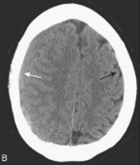 <p>- may appear isodense to the remainder of brain</p><p>- look for compressed or absent sulci, or sulci dispalced away from the inner side of the skull (white arrow)</p>