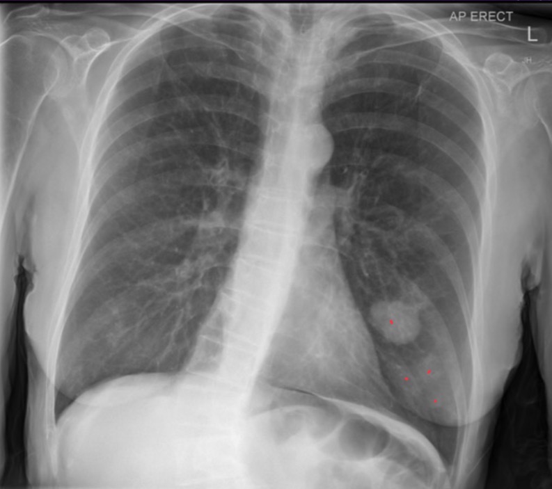 <p>65-year-old female presented with one week history of difficulty passing urine, constipation, and back pain. Patient was found to be in a hyponatremic hyperosmolar and euvolemic state. Serum osmolality is low but urine osmolality is high, urine sodium is high. Pt suspected to have SIADH. no respiratory sx, no smoking hx or fhx of ca.</p>