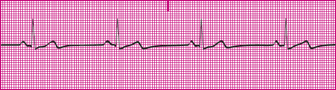 <p>Which rhythm is this?</p>