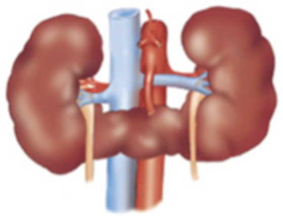 <p>Horseshoe kidney is the ___ of the polar regions of the kidneys during fetal development. Almost always involves the ___ poles. Usually located ___ in the ___ than usual. Associated with ___ pelvis, dilated ___ that are prone to infection (pyelocaliectasis), and ___.</p>