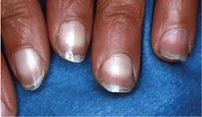 <p>Name this + its etiology</p>