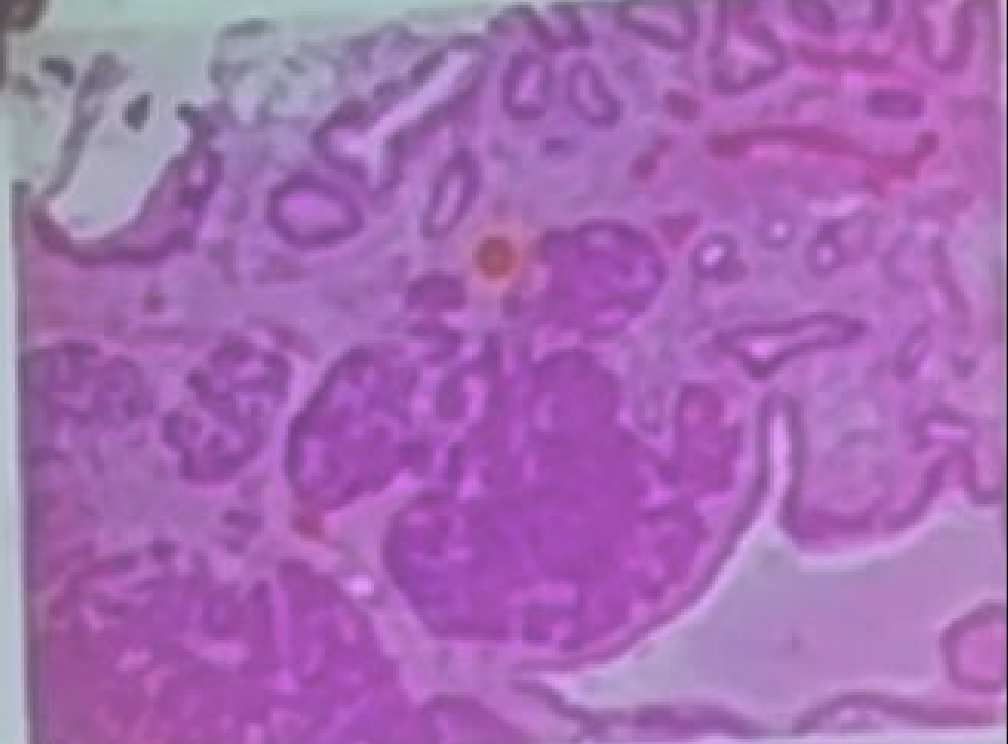<p>pancreatic acini in stomac, diagnosis</p>