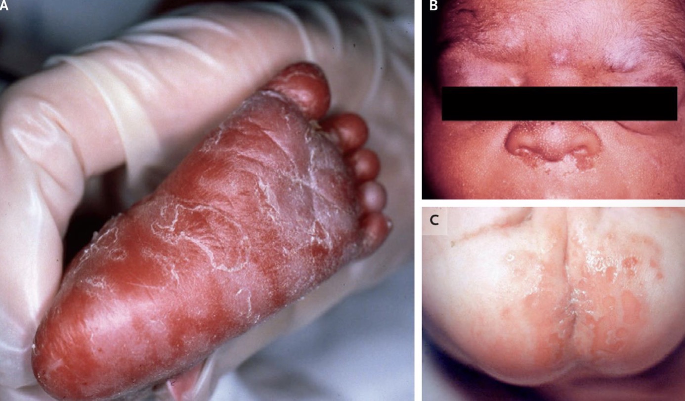 <p>Desquamation of hands and feet </p>