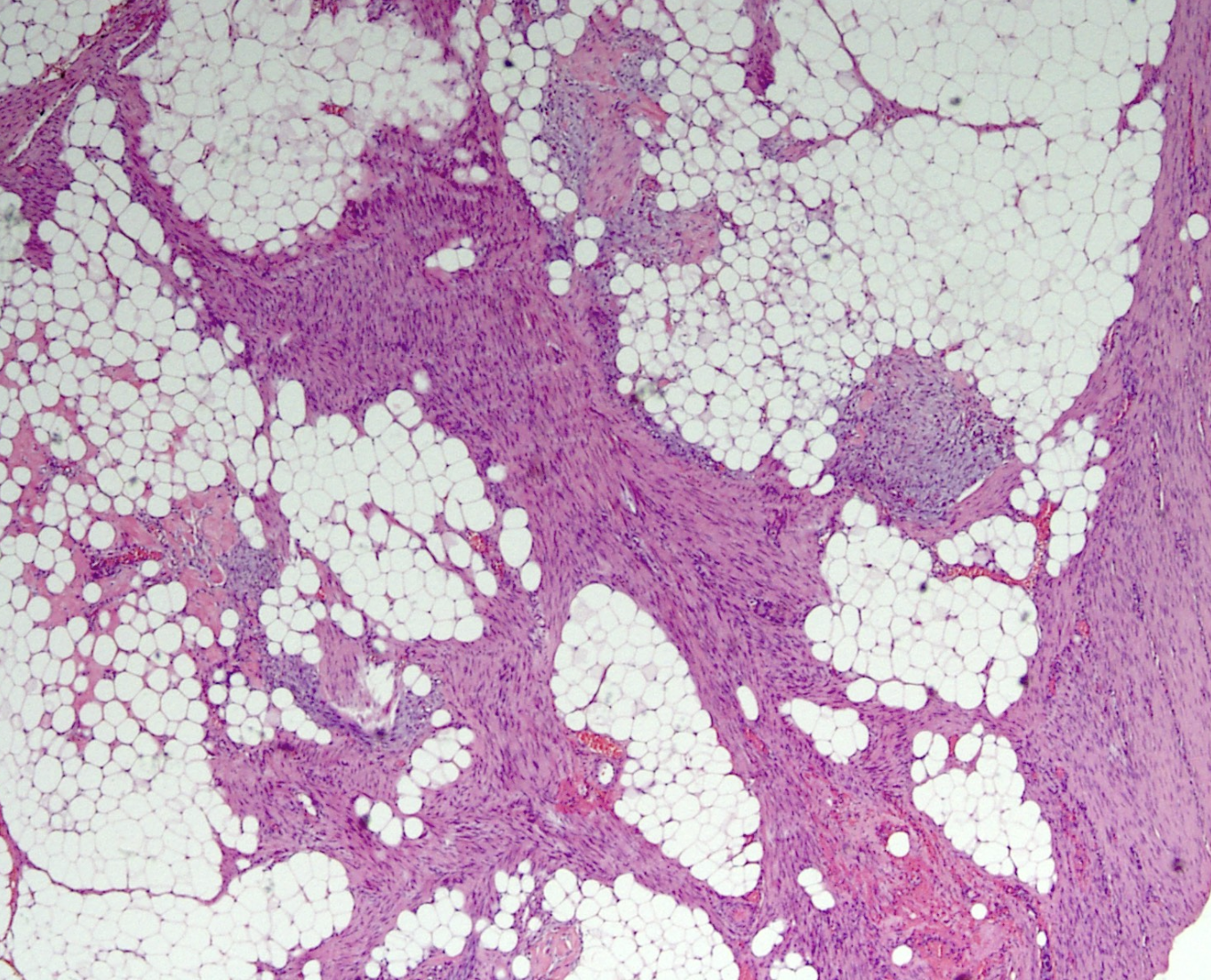 <p>nodule sous cutané enfant de 2 ans </p><p>Diagnostic</p><p>Age</p><p>Histologie</p><p>IHC</p><p>Moléculaire</p>