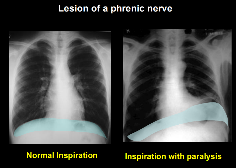 <p><span style="background-color: transparent;"><strong>Phrenic Nerve Injury:</strong></span></p><ul><li><p><span style="background-color: transparent;">If a phrenic nerve is damaged (e.g., by a tumor), that half of the diaphragm becomes paralyzed. </span></p></li><li><p><span style="background-color: transparent;">On a chest X-ray during inspiration, the paralyzed side will <strong>rise</strong> (paradoxical movement) because it is pushed up by abdominal pressure instead of contracting downward.</span></p></li></ul><p></p>