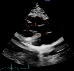 <p>Right Ventricular Inflow Tract (2D)</p>