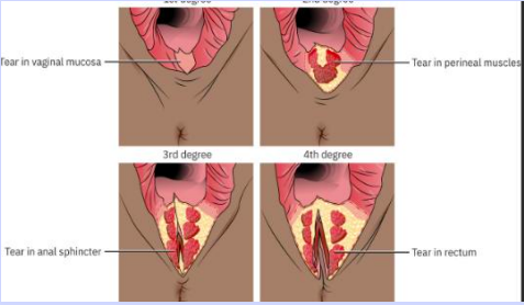 <p>1st degree: superficial vaginal mucosa / perineal skin</p><p>2nd: vaginal mucosa, perineal skin, &amp; deeper tissues</p><p>3rd: same as 2nd + anal sphincter</p><p>4th: extends through anal sphincter into rectal mucosa</p>